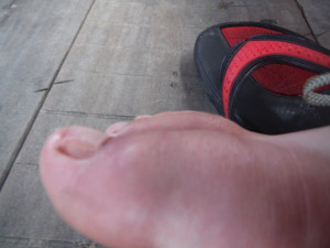 Swelling Toe